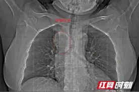 医生巧手切除纵膈肿瘤 为患者卸下胸中“炸弹”图片