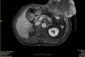 62岁老人腹部长出排球大小肿瘤！湘雅多学科专家成功切除图片