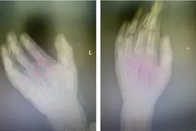 4岁小朋友手指被“夹断”，医生提醒：这些情况要特别注意图片