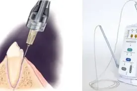 拔牙恐惧克星——无痛微创拔牙技术图片