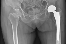 86岁老人时隔9年再次股骨颈骨折，系统性治疗是关键图片