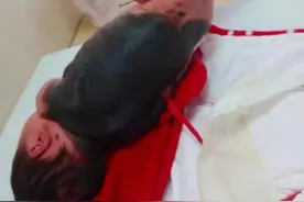 新生儿身上皮肤长满黑斑，被确诊为“巨大黑色素痣”图片