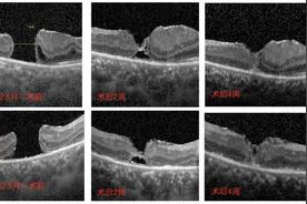 外伤黄斑裂孔术后演变成难治性黄斑裂孔，小孩千里寻医挽救 “视” 界图片
