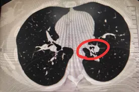 女子被鱼刺卡住半月，气管镜下“托”回一命图片