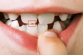 门牙上的“豁”真是嗑瓜子惹的祸？多年来的困惑终于解开了！图片