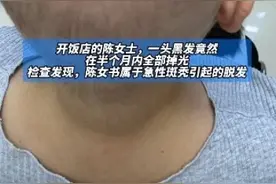宁波一女子长期熬夜致头发半月掉光，事后又长出，医生：急性斑秃较易治疗图片