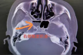 女子“鼻涕”流不停，一查竟是脑袋“漏”了图片