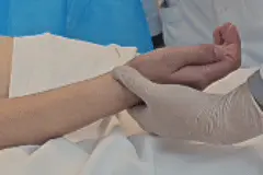 吉大二院实施省内首例脊髓电刺激术，为高位截瘫患者重燃新希望图片