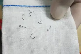 女子做痔疮手术留“隐患”：10年8次手术取出30多枚钛钉；法院判赔62万图片