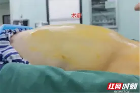 肚子越减越肥？原来是5个肿瘤在作祟，有这些症状千万别忽视图片