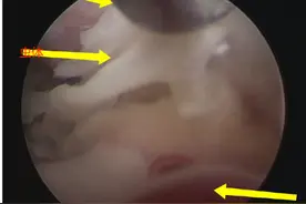 女子头晕就医 医生在其脑内取出猪肉绦虫图片