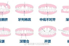 儿童牙齿排列不齐应及时诊治图片