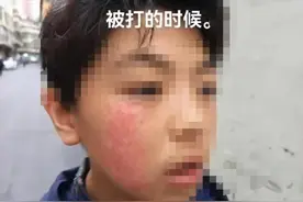 小学生被老师连扇耳光患白癜风？涉事学校：正在处理图片
