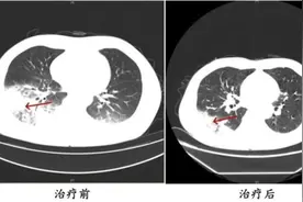 空调长期未清洁，两人感染军团菌肺炎住院了图片