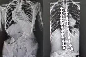 手术后，这个湖南女孩长高6厘米！经济困难脊柱畸形患者可申请救助图片