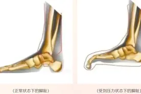 “光腿神器”暗藏健康隐患 医生建议这样选择图片