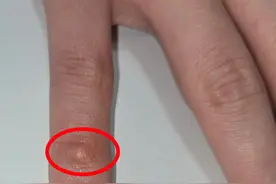 男子手上莫名长出包块，一查竟是手机惹的祸？这个行为很多人都有图片