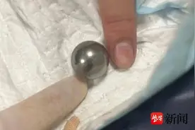 又见熊孩子，这次吞了一个直径2CM的钢珠图片