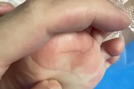 半岁女婴哭闹不止，竟是头发丝“钻”进脚底皮肤图片