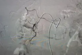 十二指肠溃疡大出血危在旦夕 益阳医专附属医院介入栓塞术助患者转危为安图片