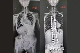 一个暑假“长高”6厘米   爱心救治帮16岁女孩“撑腰”图片