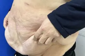 减重或产后腹部皮肤松弛下垂怎么办？腹壁重塑了解一下图片
