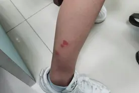 女子撸猫撸出事！未被抓挠却瘙痒无比，皮肤专家详解图片