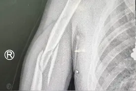 连续两例！咔嚓一声，胳膊断成三截！这种游戏别太“上头”图片