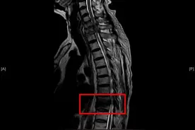 腰酸背疼不可一“贴”了之， 警惕脊柱结核导致瘫痪图片