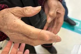 健康小站丨野蛮生长的“痛风石”究竟是什么？图片