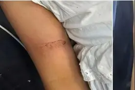 惊险！女童抓娃娃时不慎被机器电击，医生提醒图片