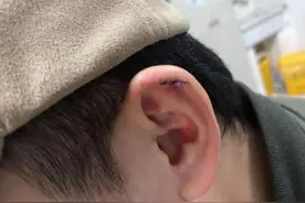 事发上海连锁美发店！小伙耳朵被剪掉一块肉：缝了6针，衣服全是血图片