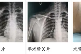 儿童骨折切莫愁，选对方法是关键图片