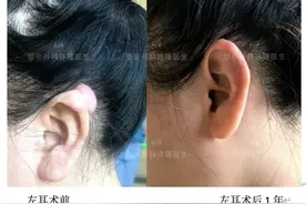 科普｜“小”耳洞也会引发“大”疙瘩，如何治疗和预防？图片