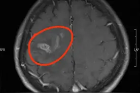 生鱼片和螺丝爱好者注意了！一男子颅内被寄生虫钻出“隧道”图片
