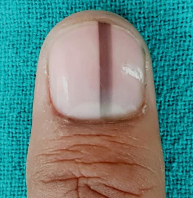 指甲上没有月牙，是我身体虚吗？