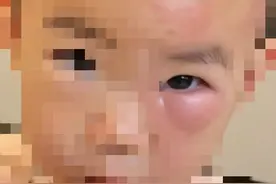 有娃被叮成“肿眼泡”，有娃被咬成“香肠嘴”......秋蚊子为啥这么毒？图片