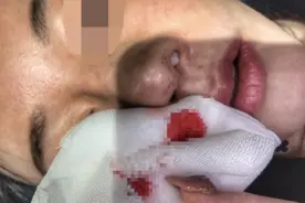 女子整容后，骨头从鼻腔里戳出！图片