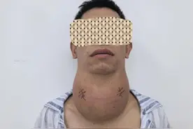 男子患“大脖子”病 医生巧手摘除589克甲状腺肿块图片