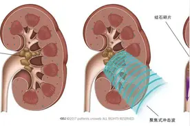 看场演唱会把肾结石震碎了？医生：还真有这种可能图片