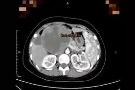 少女体内竟发现拳头大肿瘤！此前一口气吃了15个饺子图片
