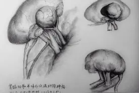 为保住患者的肾：华山医院医生取出肾脏，切瘤后再植回体内图片