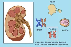 结石谜团，摘瘤断根图片