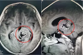 小学生考试答一题空一题，竟是因脑肿瘤导致视物重影图片