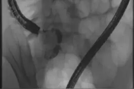 【垂医科普】消化内科：阑尾炎不必切阑尾 | 内镜下阑尾治疗术（ERAT）图片