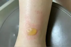 一觉醒来，身上多了一个大水疱，天气一冷，取暖千万要当心！图片