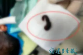 头皮发麻！男子反复流鼻血，医生一查傻眼：取出一整条……图片