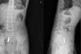 可怕！上海7岁男孩紧急手术，险酿大祸！医生提醒图片