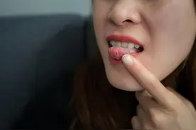 口腔溃疡，撒点盐、喝点酒，消消毒可治愈吗？图片