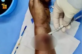 大动脉断了！男子拆快递拆进手术室，这个动作千万当心，很多人这样做……图片